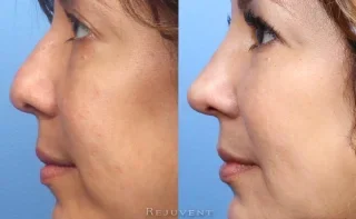 Restylane Lift Non Surgical Nose Job