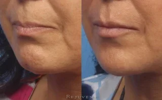 Fuller lips after filler and Wrinkle relaxer on chin