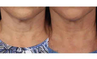 Neck firming - Patient used Nectifirm