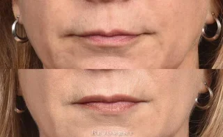 Xeomin lip flip volume before and after