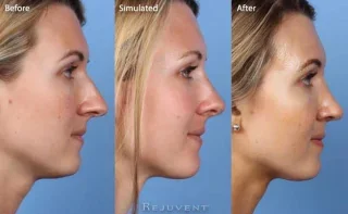 Nose surgery simulated results