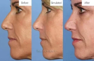 Simulated View Before and After Rhinoplasty