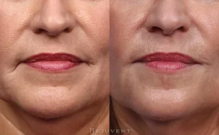 Rejuvenated lip area with Restylane Lyft in lips and marionette lines