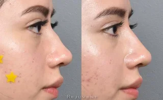 Beautiful young patient nose filler natural results