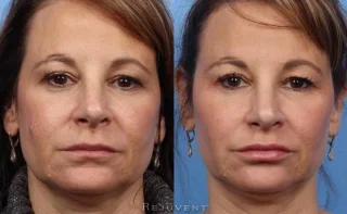 Restylane Before and After