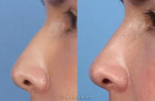 Non-Surgical nose job reduced hump with nose fillers