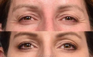 Botox for Crow's Feet Wow results