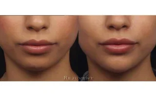 Chin sculpting non-surgical front view