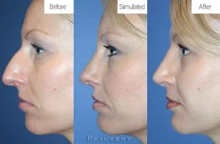 Before, Simulated and After Rhinoplasty results