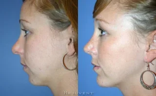Chin Augmentation Patient 2
