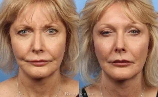 Botox frown lines before and after results