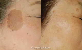 BBL dark spots can be gone