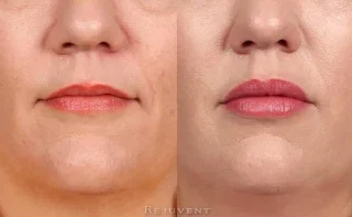 Juvederm and Restylane on lips