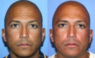 Botox Patient Forehead application Scottsdale Arizona