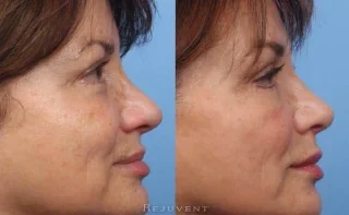 Nose filler for nose argumentation non-surgical nose results