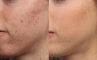 Acne Results Side 2