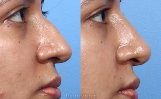 Non-Surgical Rhinoplasty beautiful results without downtime