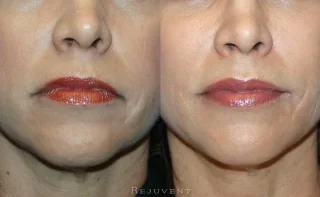 Lip Injection and Xeomin on lips