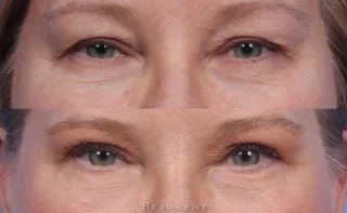 Closeup Upper Eyelid and Lower Blepharoplasty