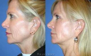 Facelift Rhytidectomy Patient Before and After