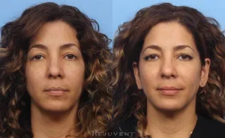 Non-Surgical nose job with Liquid Facelift