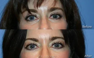 Lower Bleph Eyelid Surgery Frontal view