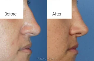 Rhinoplasty to remove nose hump with tip rotation