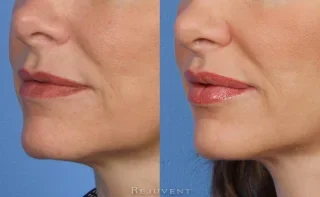 Lip Enhancement with Juvederm Restylane