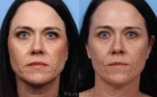 No Frowning Mouth - Not angry with Botox