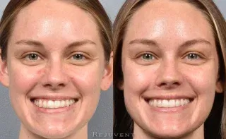 Botox Gummy Smile