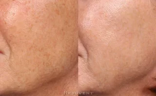 Improved pigmentation and skin texture