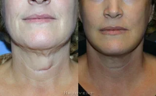 Scar Revision Patient Before and After At Rejuvent Scottsdale