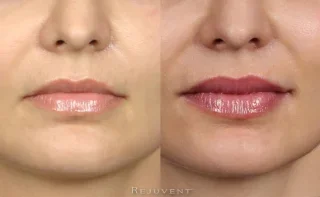 Beautiful Plump lips after lip filler injections