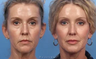 Liquid Face Lift Long Term Results in Scottsdale