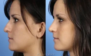 Rhinoplasty Nose Surgery 20s patient Side View