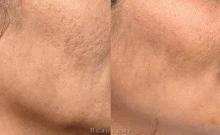 PRF before and after results