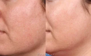 Smaller pores, better texture, less congested pores after treatment