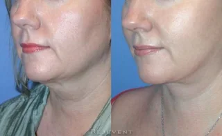 Face And Neck Lift with Corset Pt1