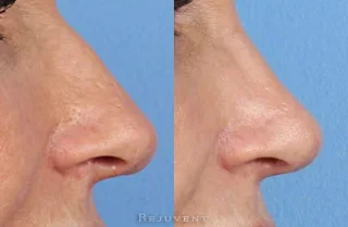 Nose Surgery Rhinoplasty Close up