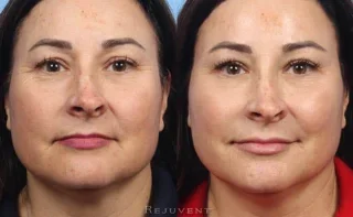 One session of Liquid Facelift