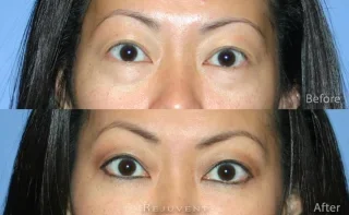 Under eye rejuvenation using derma fillers in Scottsdale