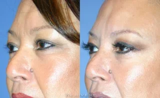 Lower Bleph Eyelid Surgery side view