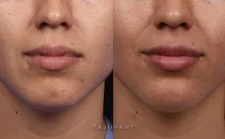 Beautiful Lips and Chin after dermal fillers at Rejuvent